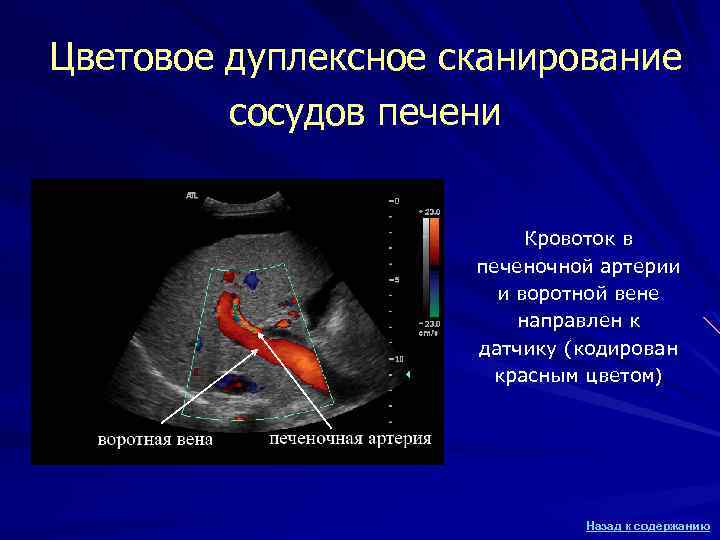 Цветовое дуплексное сканирование сосудов печени Кровоток в печеночной артерии и воротной вене направлен к