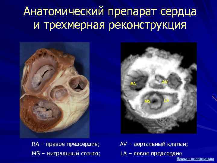 Анатомический препарат сердца и трехмерная реконструкция RA – правое предсердие; AV – аортальный клапан;