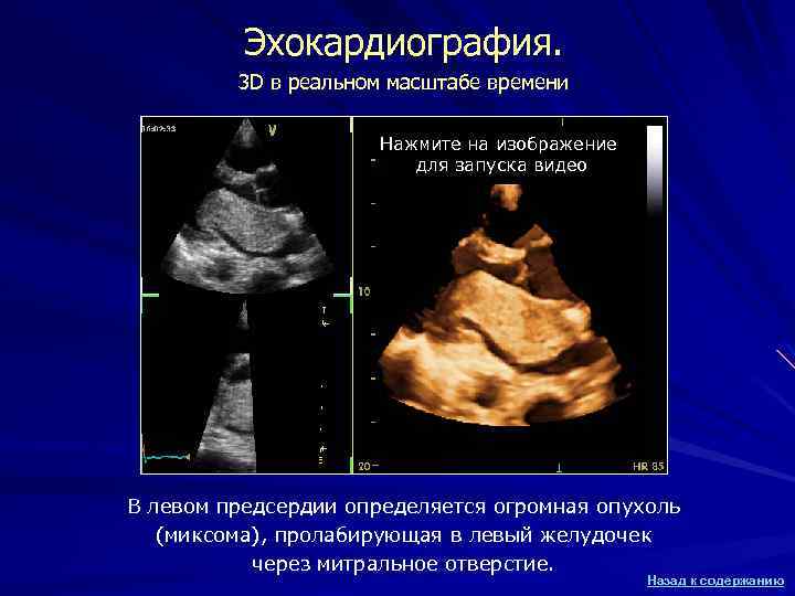 Эхокардиография. 3 D в реальном масштабе времени Нажмите на изображение для запуска видео В