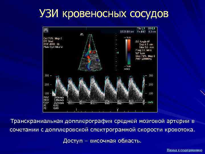 УЗИ кровеносных сосудов Транскраниальная допплерография средней мозговой артерии в сочетании с допплеровской спектрограммой скорости