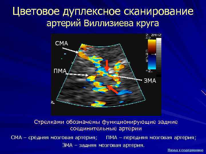 Цветовое дуплексное сканирование артерий Виллизиева круга СМА ПМА ЗМА Стрелками обозначены функционирующие задние соединительные