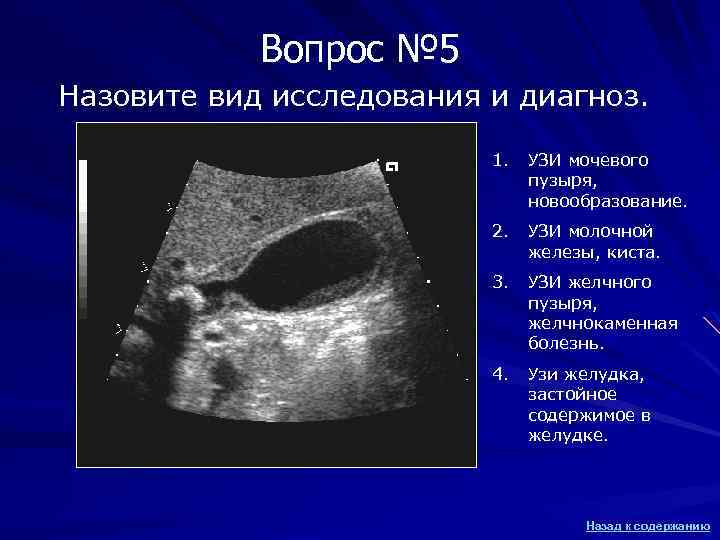 Вопрос № 5 Назовите вид исследования и диагноз. 1. УЗИ мочевого пузыря, новообразование. 2.