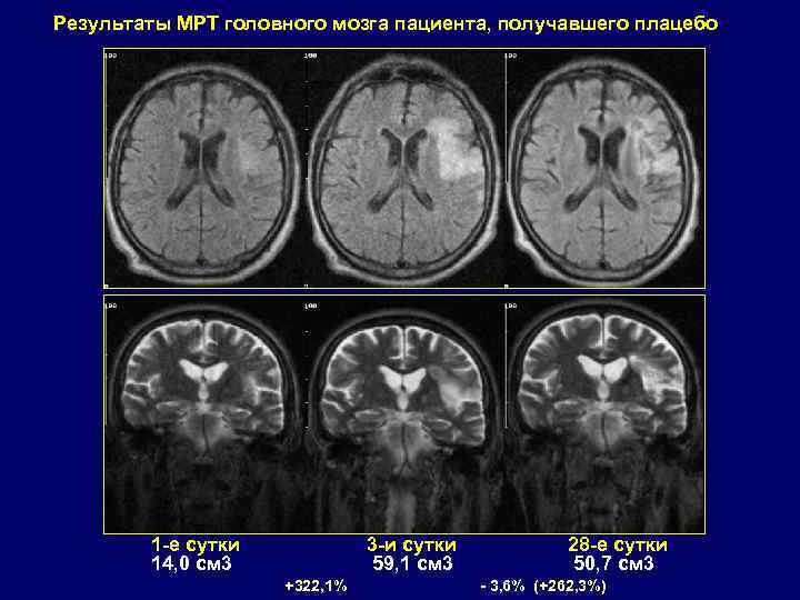 Результаты МРТ головного мозга пациента, получавшего плацебо 1 -е сутки 14, 0 см 3