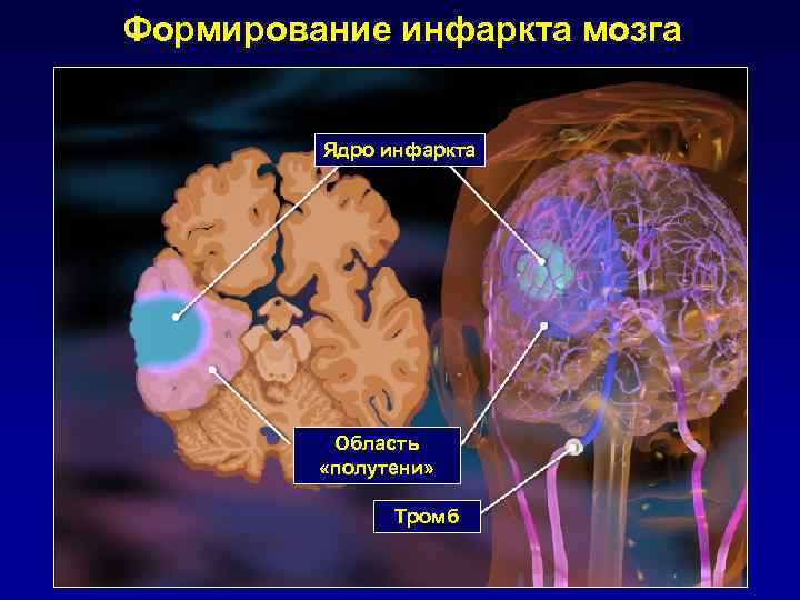 Формирование инфаркта мозга Ядро инфаркта Область «полутени» Тромб 