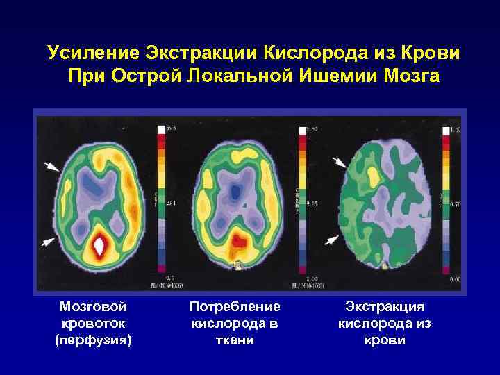 Усиление Экстракции Кислорода из Крови При Острой Локальной Ишемии Мозга Мозговой кровоток (перфузия) Потребление