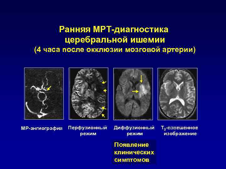 Ранняя МРТ-диагностика церебральной ишемии (4 часа после окклюзии мозговой артерии) МР-ангиография Перфузионный режим Диффузионный