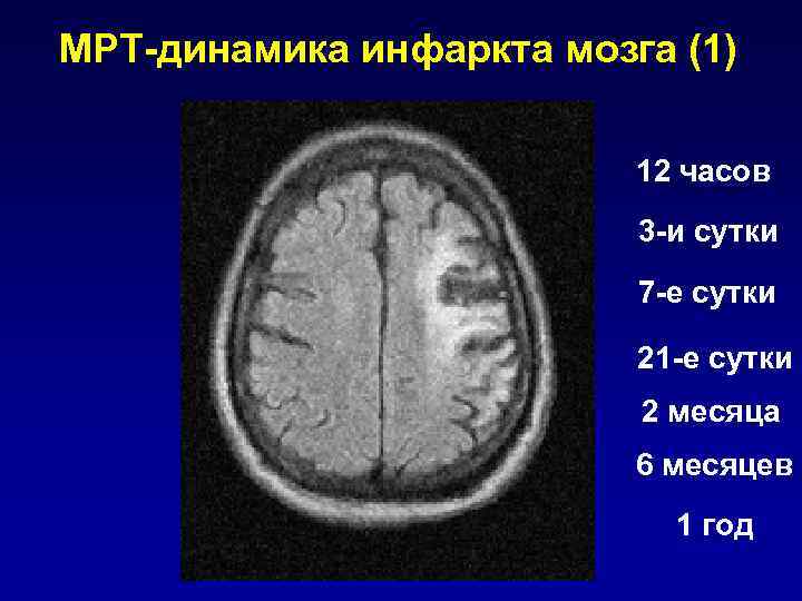 Есть инфаркт мозга