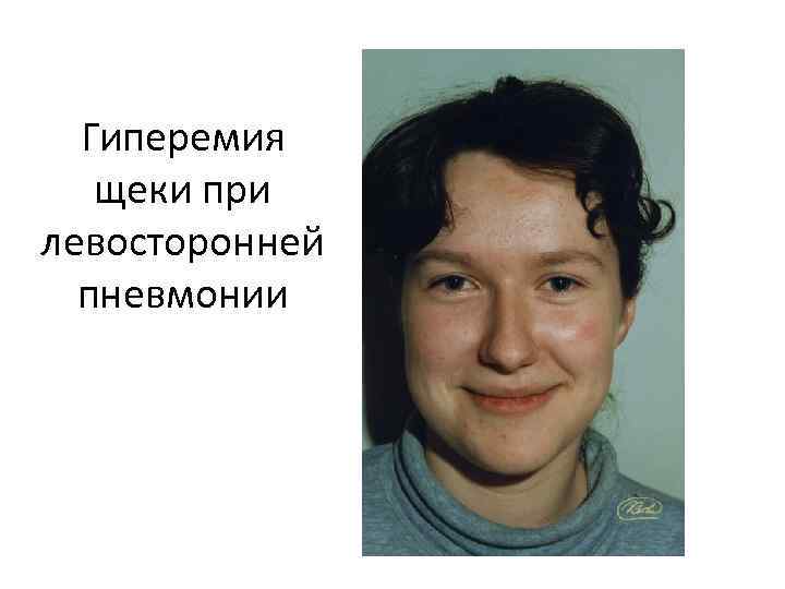 Гиперемия щеки при левосторонней пневмонии 