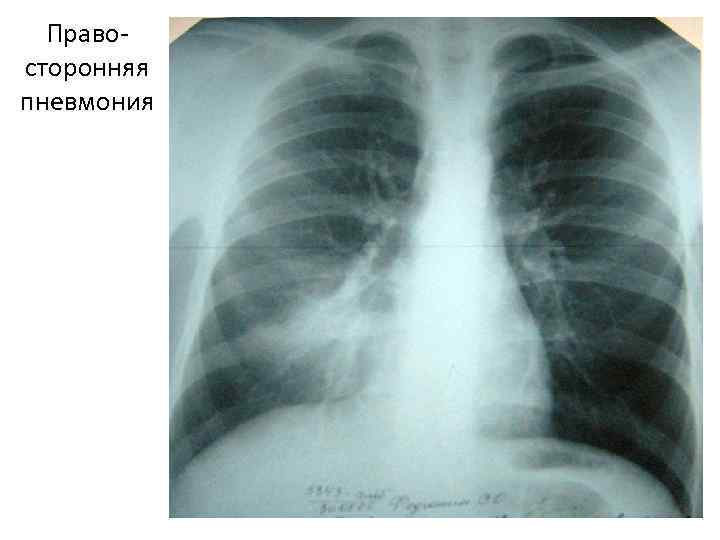 Правосторонняя пневмония 