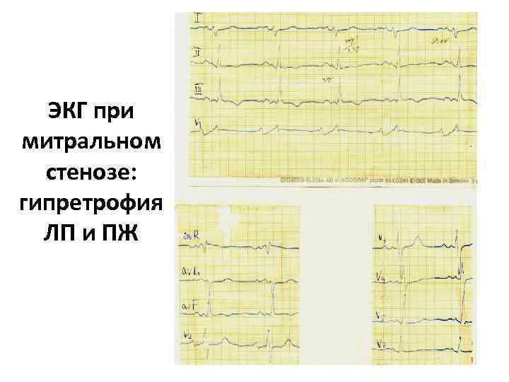 ЭКГ при митральном стенозе: гипретрофия ЛП и ПЖ 