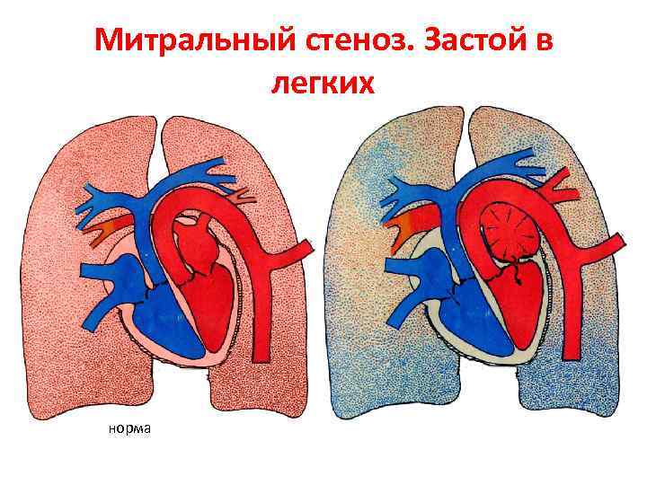 Митральный стеноз. Застой в легких норма 