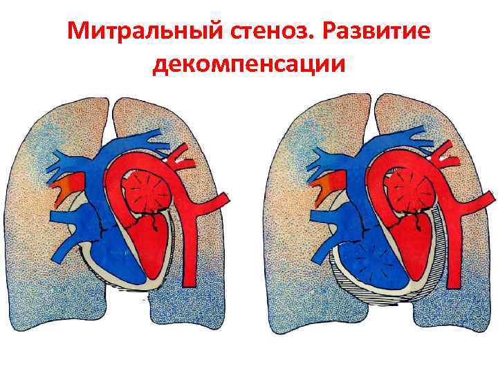 Митральный стеноз. Развитие декомпенсации 