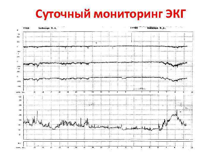 Суточный мониторинг ЭКГ 