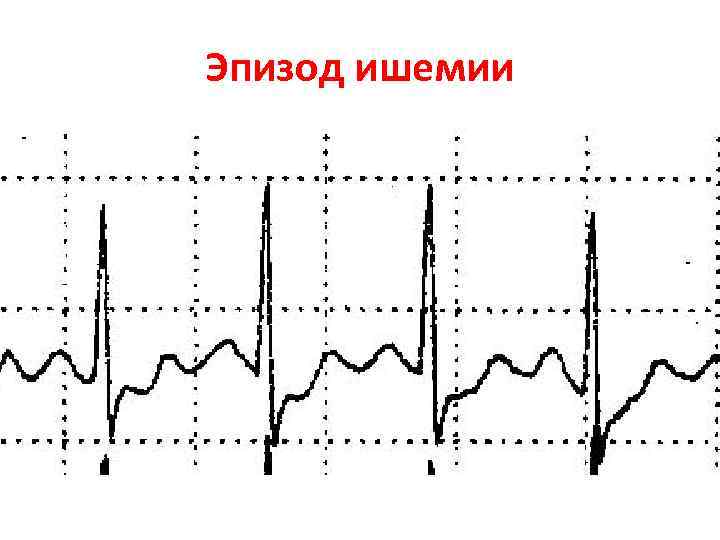 Эпизод ишемии 