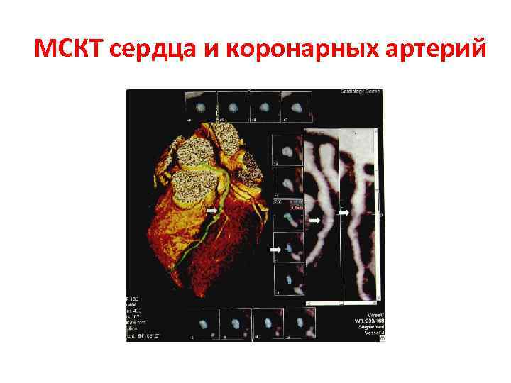 МСКТ сердца и коронарных артерий 