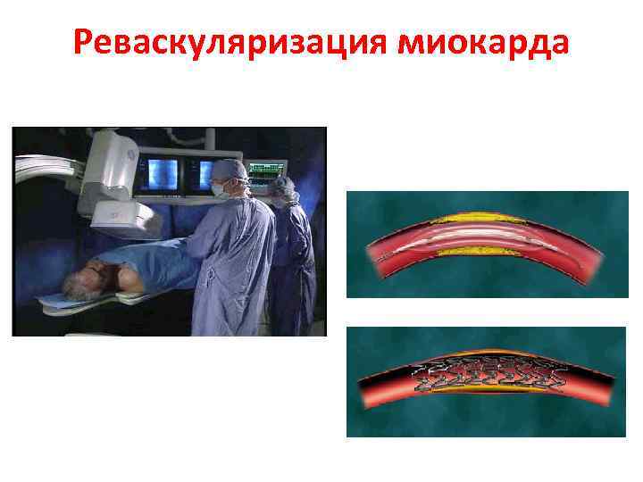 Реваскуляризация миокарда 