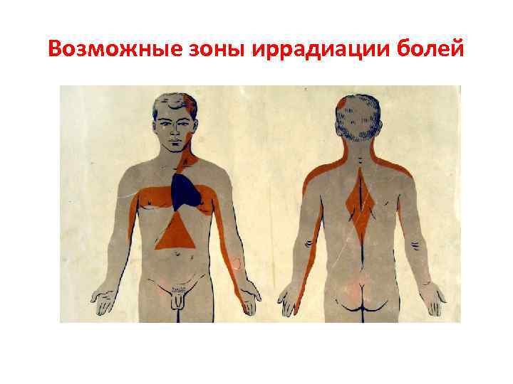 Возможные зоны иррадиации болей 
