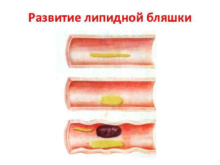Развитие липидной бляшки 