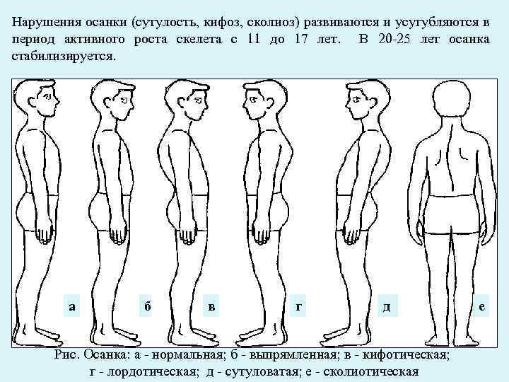 Кифоз позвоночника у подростков