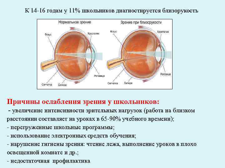 Основные причины близорукости