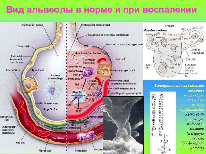 Вид альвеолы в норме и при воспалении тубулярный миелин +Ig(G, A) Поверхностное натяжение: снижение