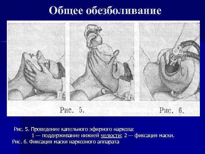 Общее обезболивание Рис. 5. Проведение капельного эфирного наркоза: 1 — поддерживание нижней челюсти; 2