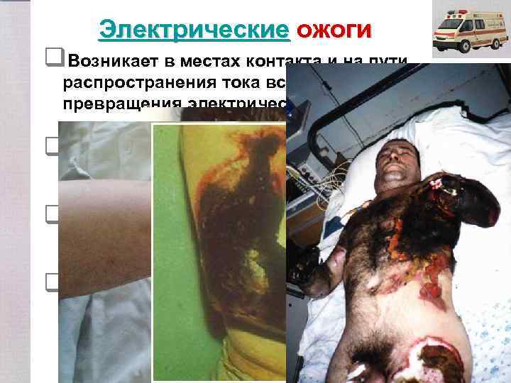 Электрические ожоги q. Возникает в местах контакта и на пути распространения тока вследствие превращения