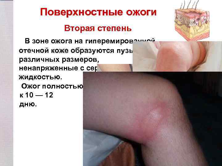 Поверхностные ожоги Вторая степень В зоне ожога на гиперемированной отечной коже образуются пузыри различных