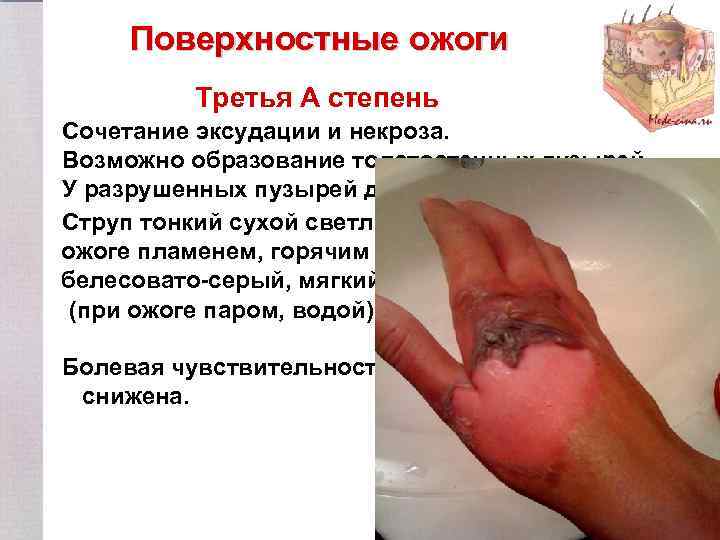 Поверхностные ожоги Третья А степень Сочетание эксудации и некроза. Возможно образование толстостенных пузырей. У