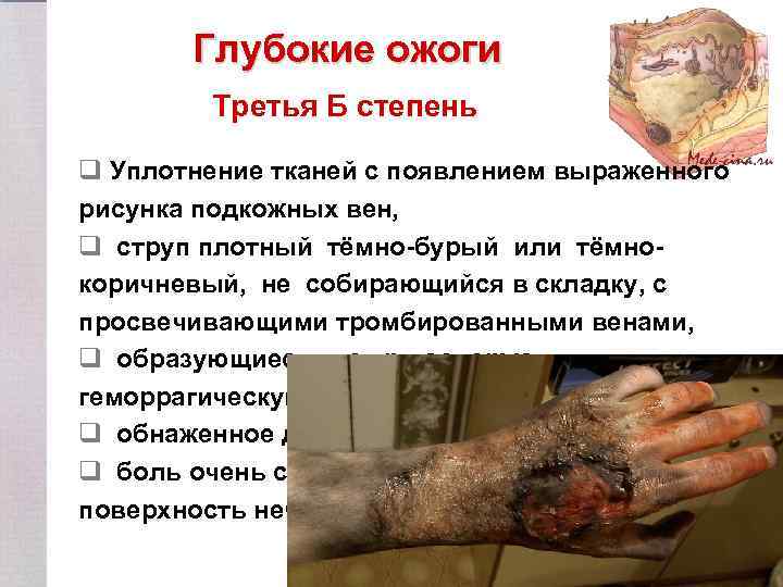 Глубокие ожоги Третья Б степень q Уплотнение тканей с появлением выраженного рисунка подкожных вен,