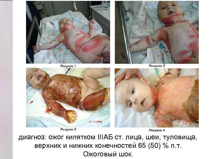 диагноз: ожог кипятком IIIАБ ст. лица, шеи, туловища, верхних и нижних конечностей 65 (50)
