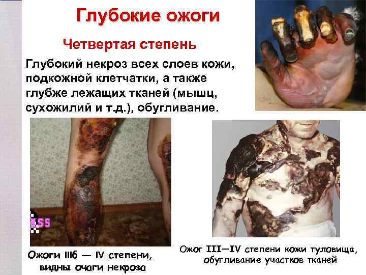 Глубокие ожоги Четвертая степень Глубокий некроз всех слоев кожи, подкожной клетчатки, а также глубже