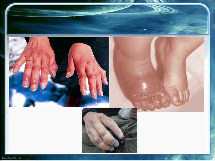  • 2 ст Рис. 4. Отморожение левой стопы II степени. 