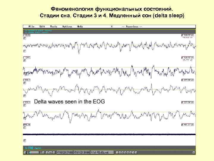Феноменология функциональных состояний. Стадии сна. Стадии 3 и 4. Медленный сон (delta sleep) 