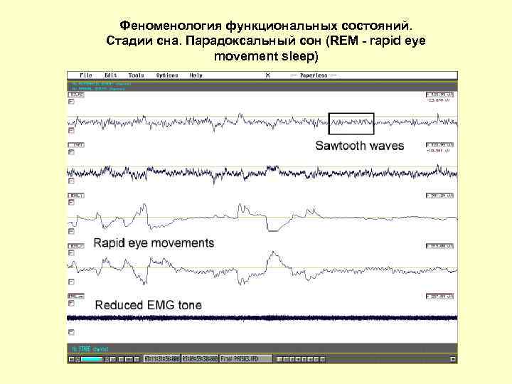 Феноменология функциональных состояний. Стадии сна. Парадоксальный сон (REM - rapid eye movement sleep) 