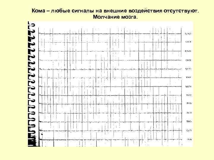 Кома – любые сигналы на внешние воздействия отсутствуют. Молчание мозга. 