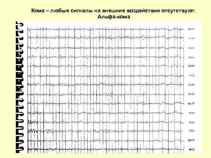 Кома – любые сигналы на внешние воздействия отсутствуют. Альфа-кома 