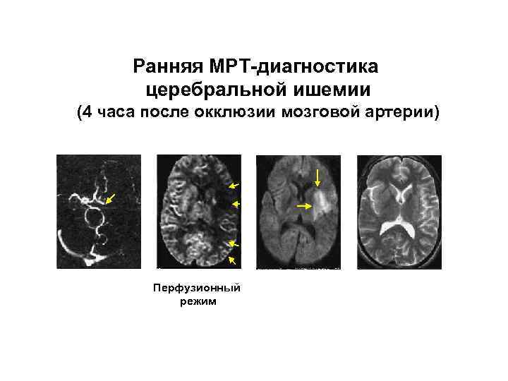 Ранняя МРТ-диагностика церебральной ишемии (4 часа после окклюзии мозговой артерии) МР-ангиография Перфузионный режим Диффузионный