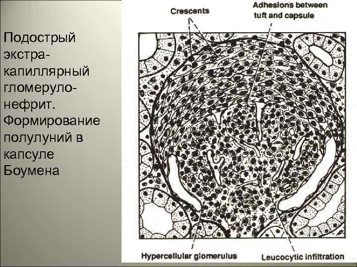 Подострый экстракапиллярный гломерулонефрит. Формирование полулуний в капсуле Боумена 14 