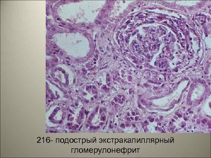 216 - подострый экстракапиллярный гломерулонефрит 15 