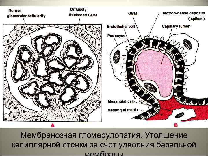 Мембранозная гломерулопатия. Утолщение капиллярной стенки за счет удвоения базальной 24 