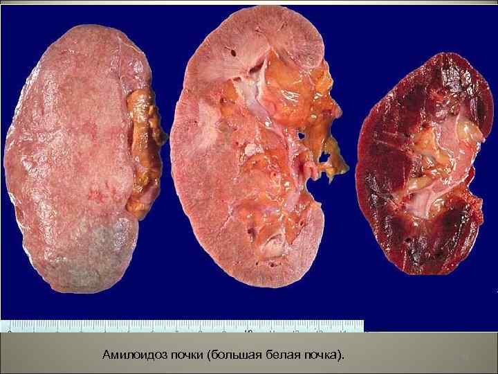 Амилоидоз почки (большая белая почка). 40 