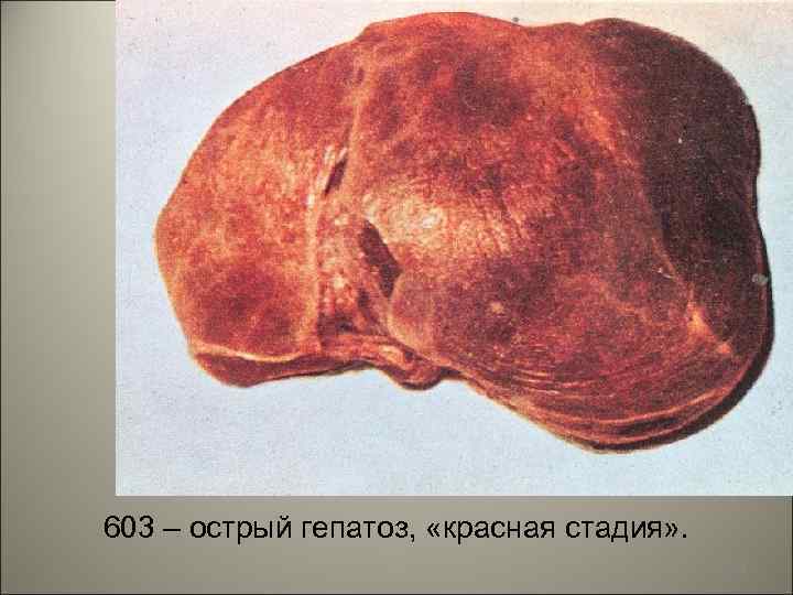 603 – острый гепатоз, «красная стадия» . 50 