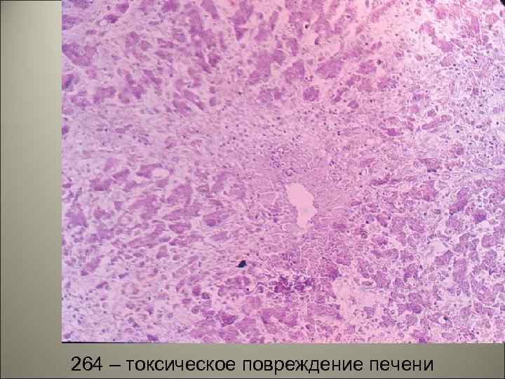 264 – токсическое повреждение печени 52 