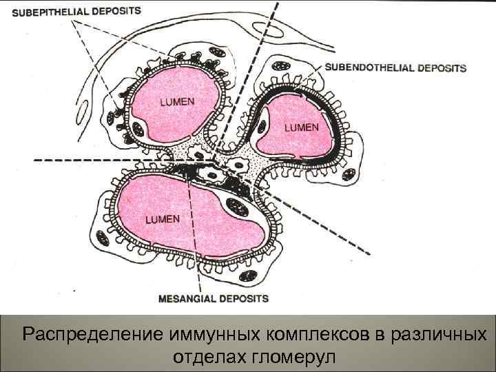 Распределение иммунных комплексов в различных 9 отделах гломерул 