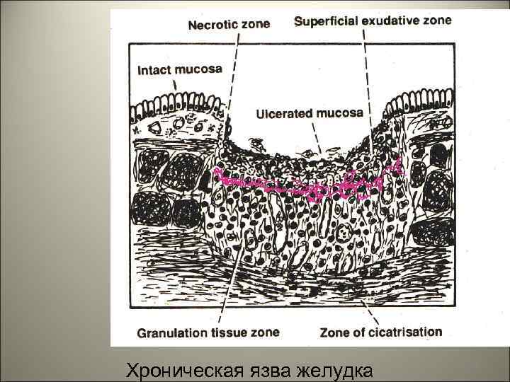 Хроническая язва желудка 98 