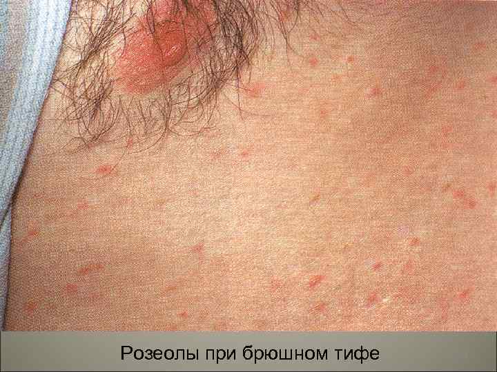 Розеолы при брюшном тифе 10 