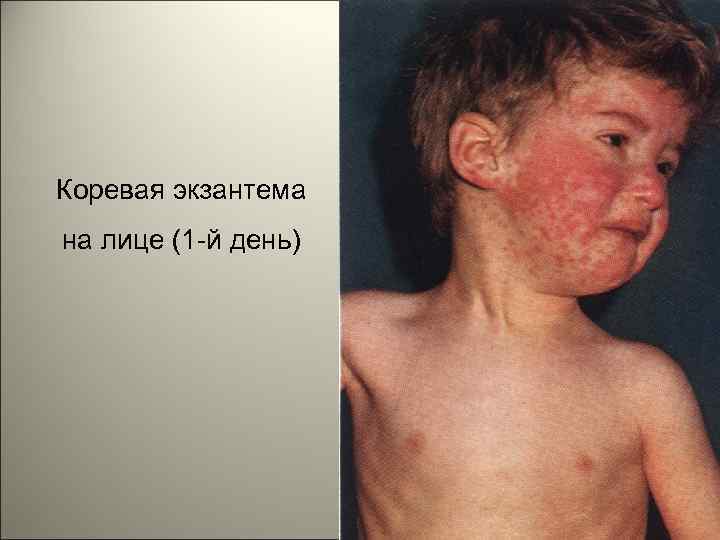 Коревая экзантема на лице (1 -й день) 100 