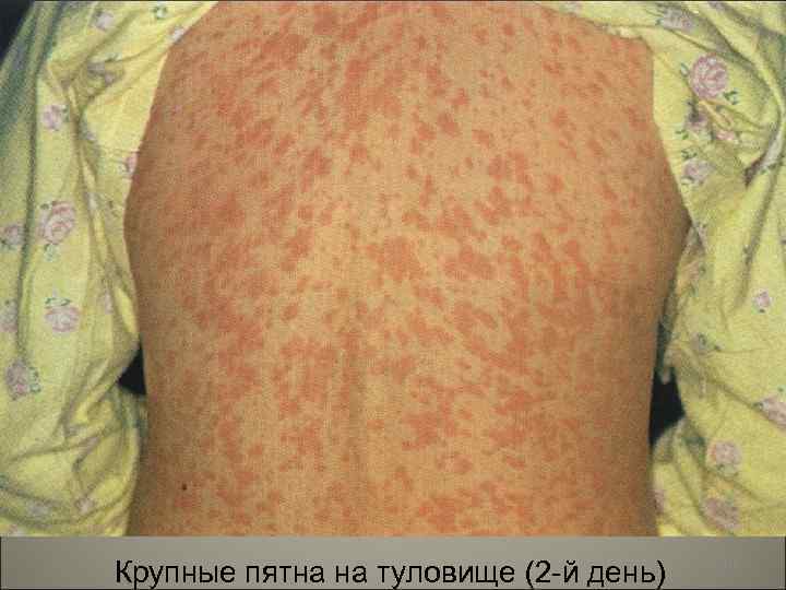Крупные пятна на туловище (2 -й день) 101 
