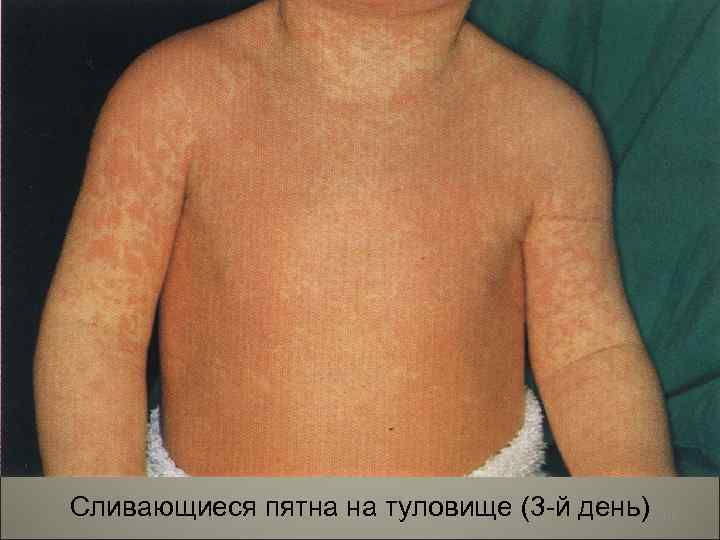 Сливающиеся пятна на туловище (3 -й день) 102 